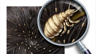 How to Get Rid of Head Lice Fast - Home Remedies For Lice