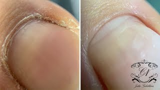 ИДЕАЛЬНЫЙ ПЕДИКЮР и покрытие гель лаком. Донаращивание углов. ДО и ПОСЛЕ