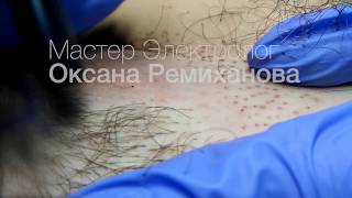Электроэпиляция зоны бикини Донецк