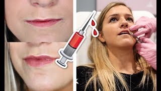 My HONEST Lip Injection Experience