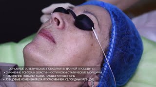 Фракционное омоложение кожи. Fraxel| Лазерная шлифовка кожи лица |Fraxel Одесса