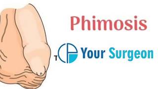 फिमॉसिस or phimosis or tight foreskin - सब कुछ हिंदी
