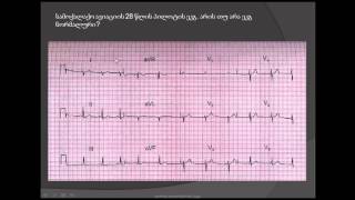 მარჯვენა პარკუჭის ჰიპერტროფია / marjvena parkuchis hipertrofia /კარდიოგრამის ანალიზი / U კბილი
