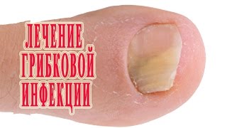 ★Лечение Грибка стопы и ногтей на ногах. Причины. Виды. Симптомы. Профилактика.