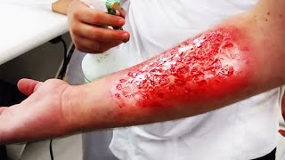ПЕРВАЯ ПОМОЩЬ ПРИ ОЖОГАХ (ОЖОГИ 1,2,3,4 СТЕПЕНИ)