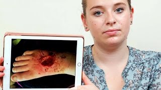 Girl Pays To Have Her Leg Amputated After Ingrown Toe Nail