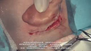 Кохлеарная имплантация
