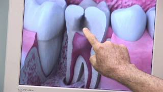 Dental Health & Gum Disease : What Does a Cavity Look Like?