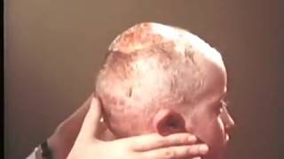 Глубокая трихофития - инфильтративно-нагноительная © Deep Trichophytosis