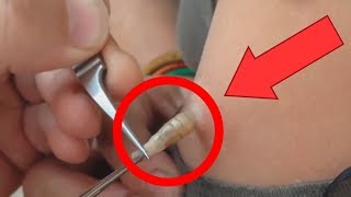 САМЫЕ МЕРЗКИЕ ПАРАЗИТЫ И ИХ УДАЛЕНИЕ