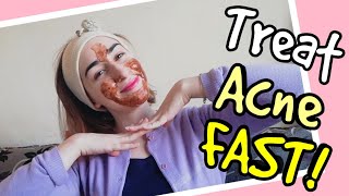 How to Treat Acne FAST! (The ONLY Remedy Every Guy/Girl NEEDS.)