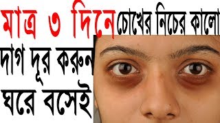 মাত্র ৩ দিনে চোখের নিচের কালো দাগ দূর করুন। Remove dark circles in 3 days permanently