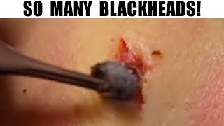 Blackhead Black Head, Blackheads | Watson