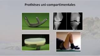 Peut-on reprendre le sport après prothèse ?