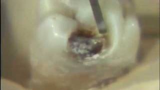 Removal of Carious Lesion