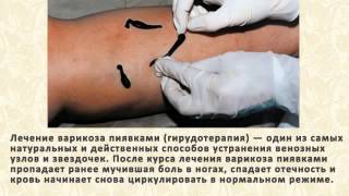 Смотреть Варикоз Большой Подкожной Вены - Варикоз Большой Подкожной Вены