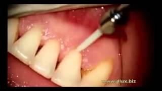 BA01 универсальная стекловолоконная насадка, Денталл Сервис, dentallservice.com.ua