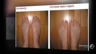 выступает косточка на ноге

  - Valgus pro купить
