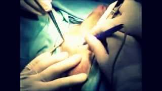 Louisa male to female surgery ,