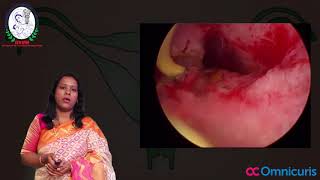 Case of Septate Uterus With Vaginal Septum
