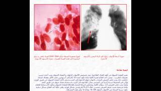 الالتهاب الرئوي Pneumonia - Health City