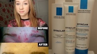 La Roche Posay Effaclar 3 Step Anti Blemish System ♡ Review