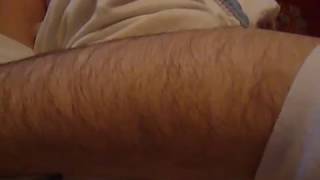 hairy female arm (hirsutism)