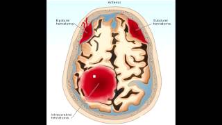 Most Common: Helminth Infection, Hematoma(epidural and subdural) & Hemochromatosis