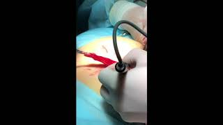 Грыжесечение( пупочная грыжа) пластика  ventralex st hernia patch 8.0sm