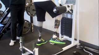 Maggi, bilateral below knee amputee