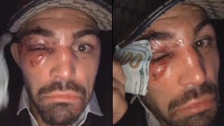 Mike Perry Reacts to Loss At UFC Orlando, Uses $100 Bill To Wipe Injured Eye
