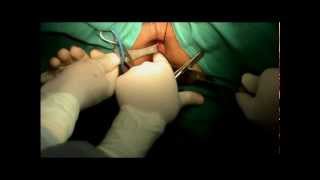 High Peri Anal Fistula- Ano- Rectal Surgery Video- Dr Rajnish Talwar