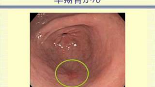 佐野 武 先生 -胃がん　早く見つけてうまく治す・前編（市民公開講座）