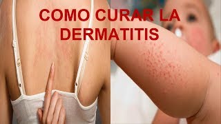 REMEDIOS CASEROS PARA LA DERMATITIS / COMO CURAR LAS ALERGIAS EN PIEL Y EN GENERAL