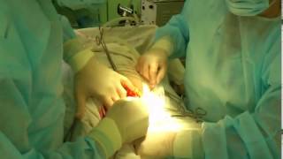 Кесарево сечение! Двойняшки! Cesarean section.