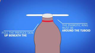 Cure Phimosis without circumcision - Phimostop Video