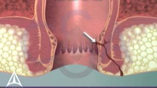 Fistula in Ano - 3D Medical Animation