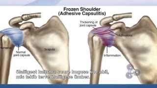 HOW TO FIX FROZEN SHOULDER: TV SHOW: ADHESIVE CAPSULITIS CURE: TRIGENICS "OAT" PROCEDURE