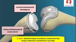 Эндопротезирование коленного сустава: основные принципы и этапы операции по замене коленного сустава