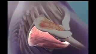 Dimostrazione 3D rottura tendine sovraspinoso spalla