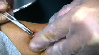 Fish Hook Emergency in the Pediatric ER