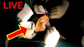 Operation Theater Experience | Below Knee Amputation live