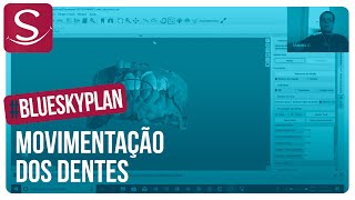 Ortodontia Digital - Blue Sky Plan: Movimentação dos dentes