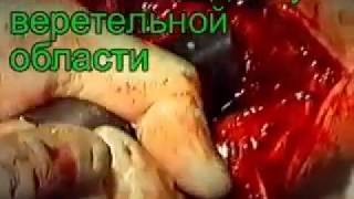 Федоров В.Г.  Операция при ЛСШБК
