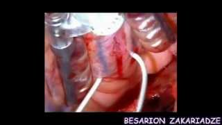 GULIS  SHUNTIREBIS  OPERACIA  BESARION  ZAKARIADZE  18 08 2012CELI