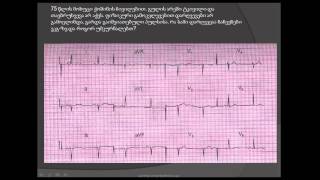 ეკგ. მეორე ხარისხის ავ ბლოკადა, მარცხენა წინა ჰემიბლოკი, გადატანილი მიოკარდიუმის ინფარქტი