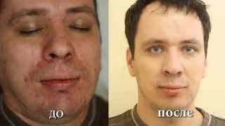 Лечение угревой сыпи. Лечение угревой сыпи лазером