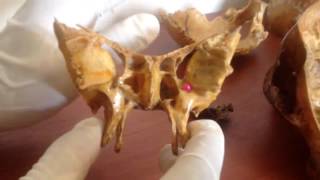 Anatomía - Práctica de Hueso Esfenoides (Cuerpo, Alas Mayores y Menores, Procesos Pterigoideos)