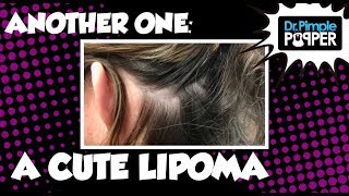 ANOTHER ONE: A Cute Lipoma