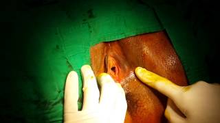 Vaginal loosening for Treatment of Painful Sex